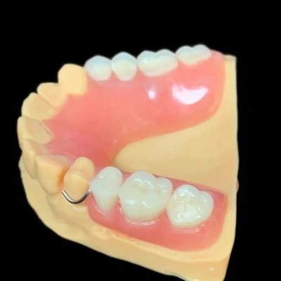 Denture parzjali li jistgħu jitneħħew bil-qafla tal-wajer
