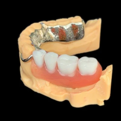 Qafas tal-metall Vitallium Bi Denture